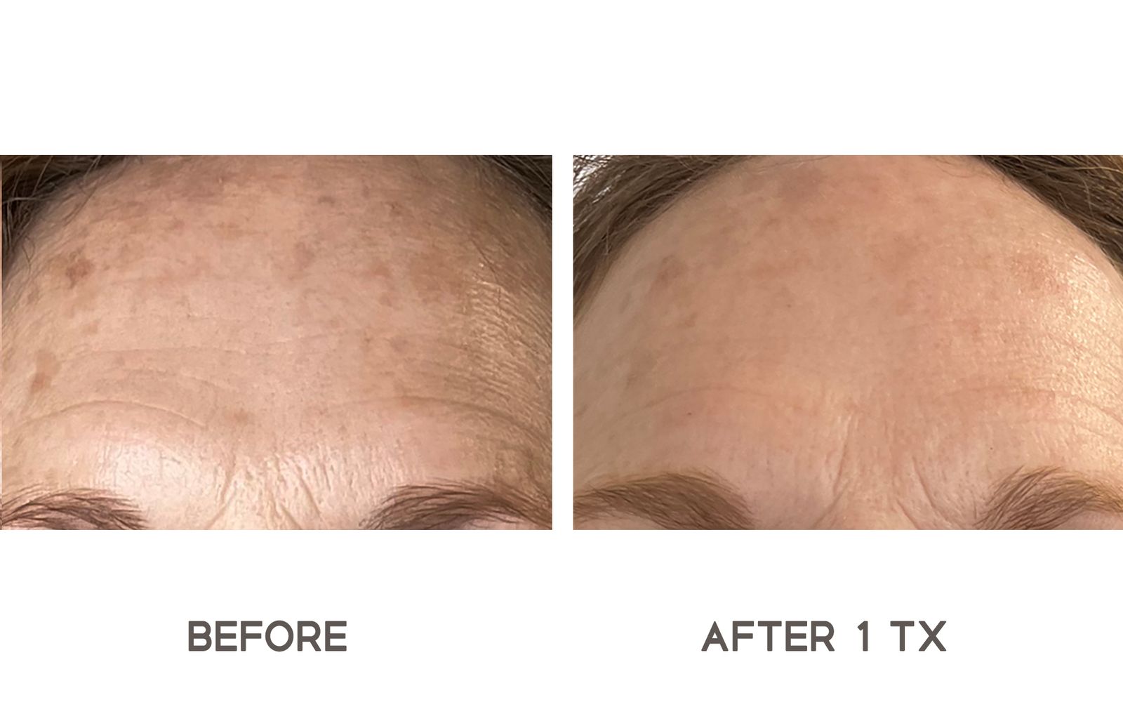 OPUS PLASMA SKIN RESURFACING OPUS PLASMA SKIN RESURFACING