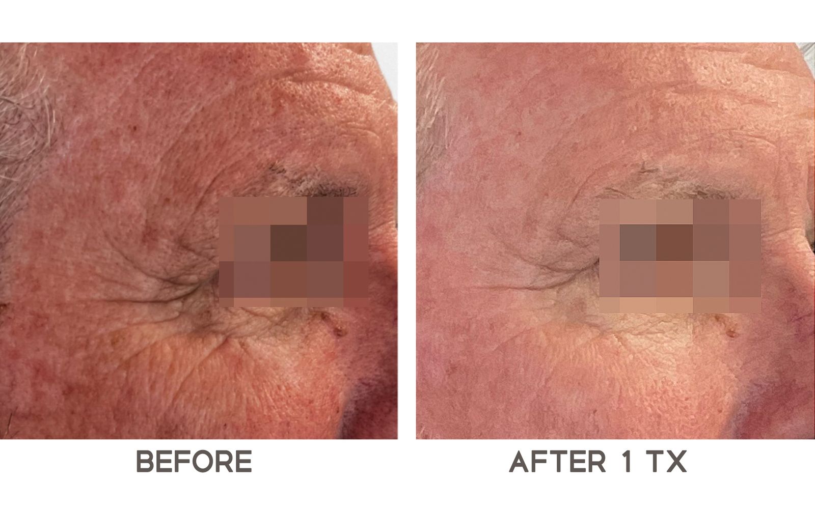 OPUS PLASMA SKIN RESURFACING OPUS PLASMA SKIN RESURFACING